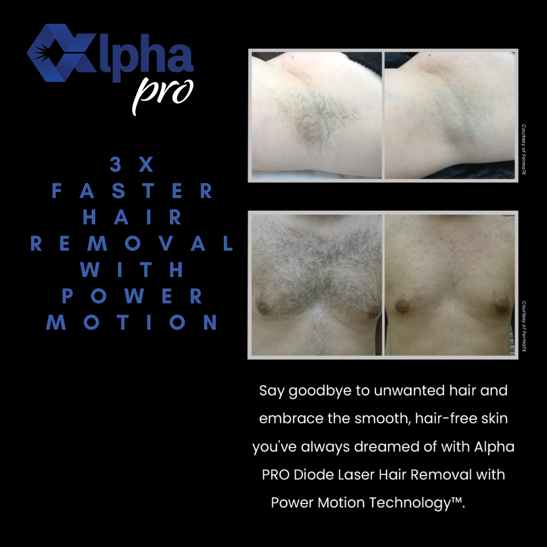 Alpha Pro laser hair removal before and after