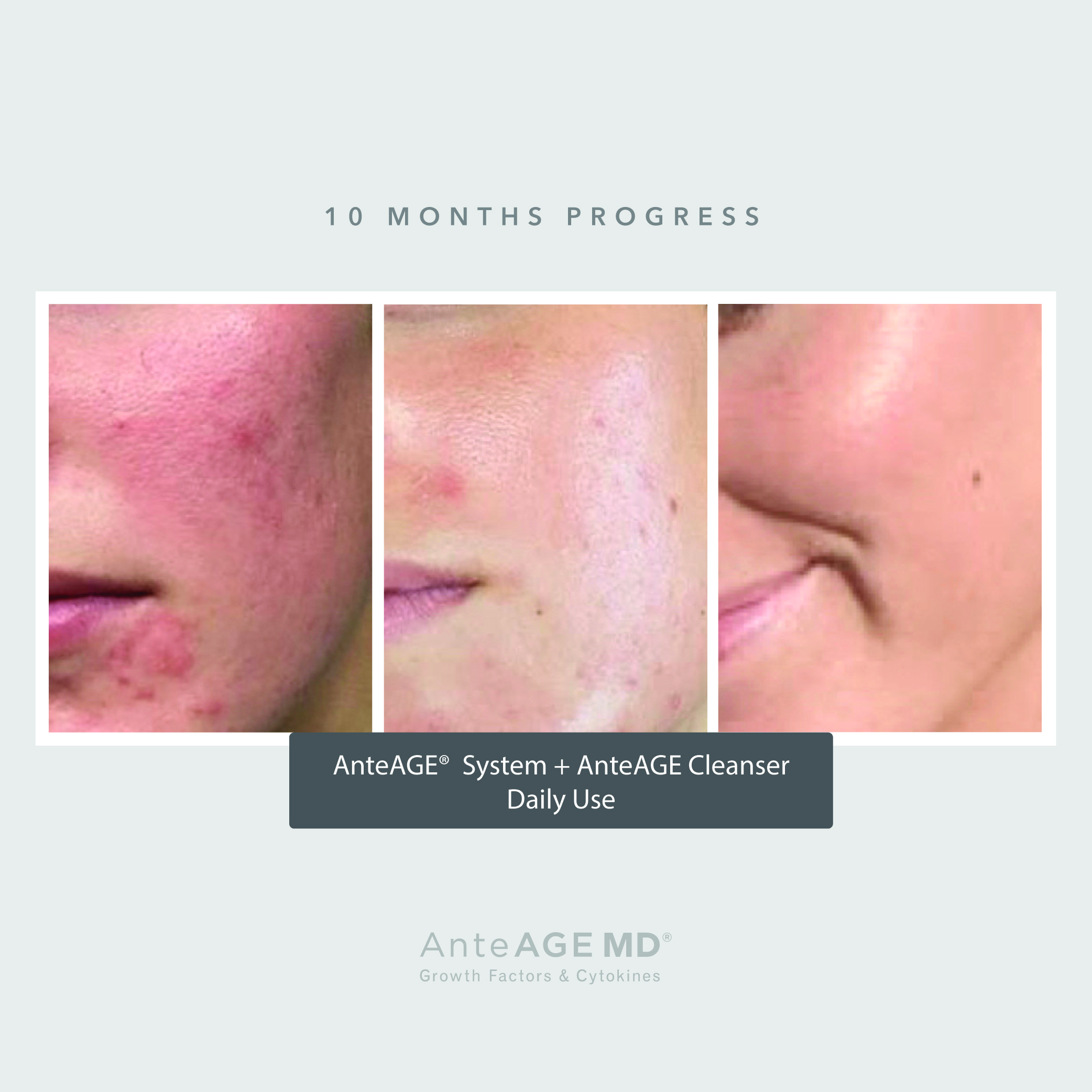 Microneedling