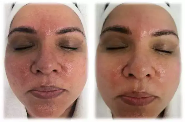 Aquafirme XS before and after — complexion