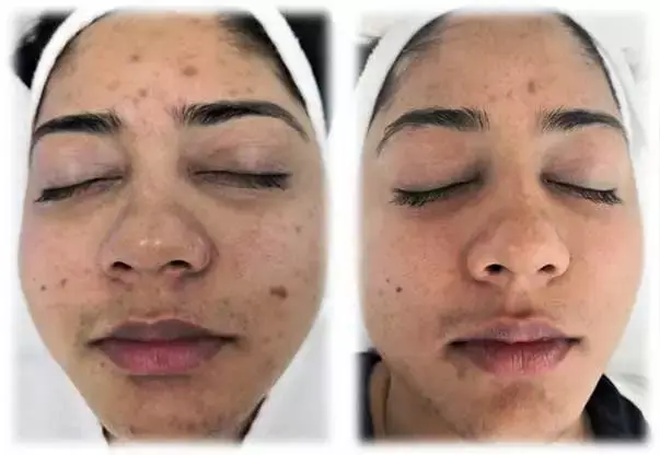 Aquafirme XS before and after — tone