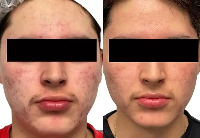 Aquafirme XS treatment result