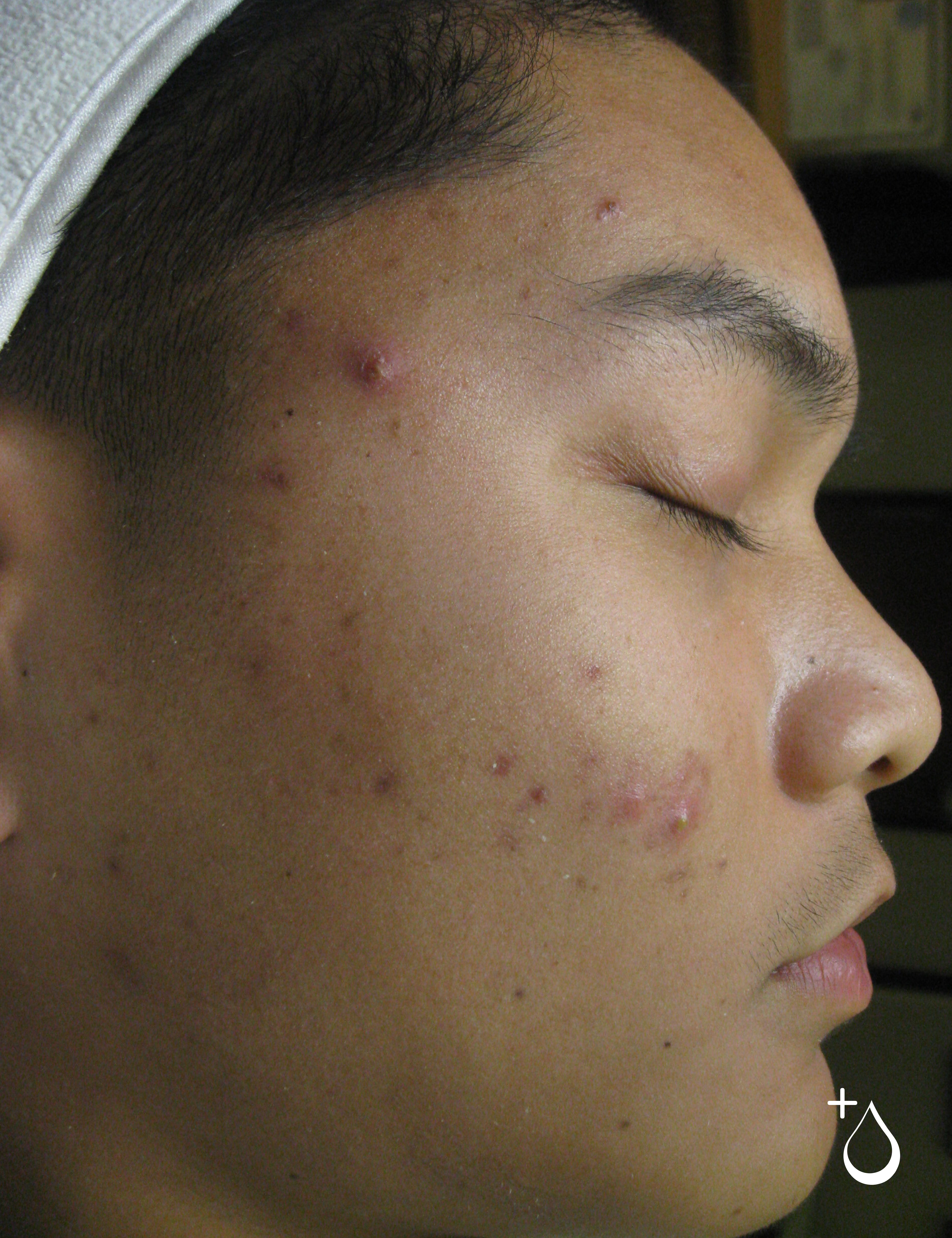 Before — acne skin prior to Face Reality Bootcamp
